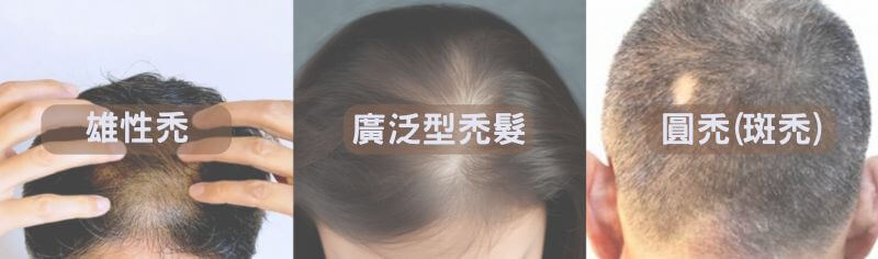 不同成因的禿髮類型圖: 雄性禿、廣泛型禿髮、圓禿(斑禿)